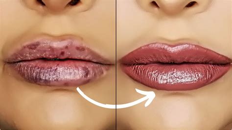 Bruise From Lip Filler Lips Makeupview