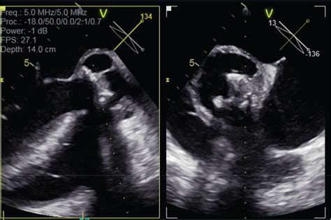 A Rare Case Of Vagococcus Fluvialis Prosthetic Valve Endocarditis And