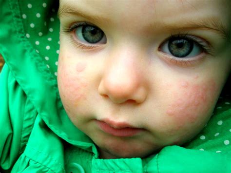 Крапивница у детей как выглядит заболевание его причины симптомы и
