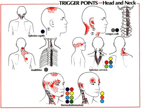 Pain Relief Pain Relief Therapy Trigger Points Head And Neck
