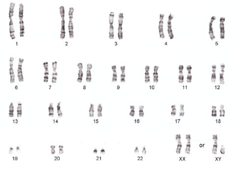 Karyotype Definition Disorders And Analysis Video And Lesson Transcript
