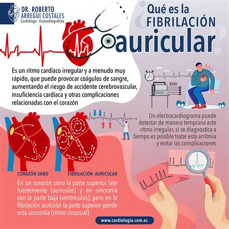 ¿qué Es La Fibrilación Auricular — Dr Roberto Arregui Cardiólogo Quito
