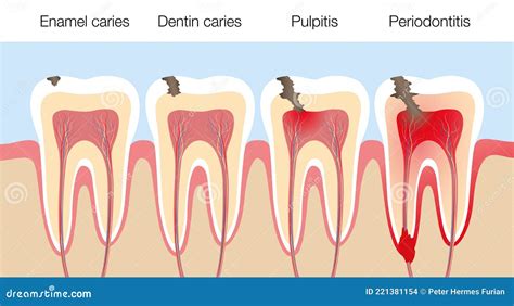 Pulpitis And Healthy Tooth Vector Illustration Cartoondealer