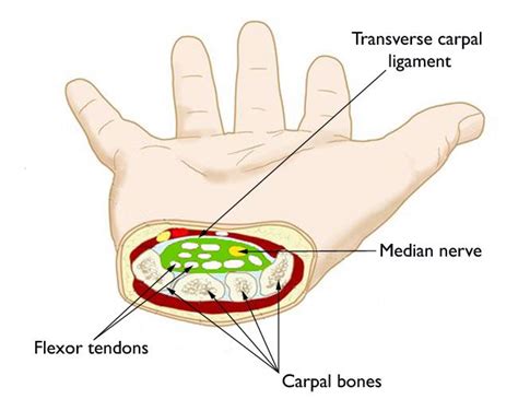 Carpal Tunnel Syndrome Symptoms And Treatment Orthoinfo Aaos
