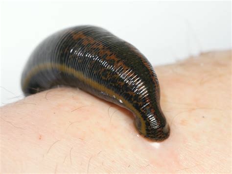 Watch See How Leeches Can Be A Surgeons Sidekick Ncpr News