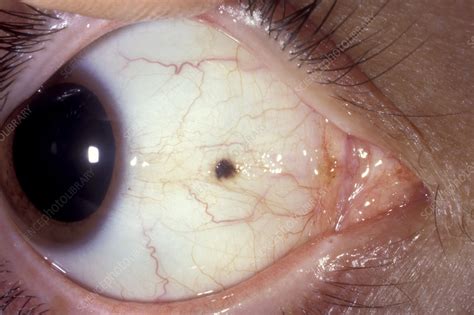 Conjunctival Naevus Stock Image C0546344 Science Photo Library