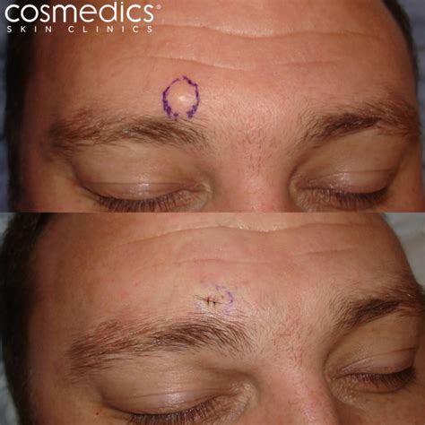 Self Removal Of Sebaceous Cyst