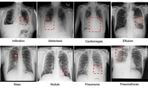 Pneumonia Vs Pleural Effusion X Ray Understanding The Differences Universe Rant