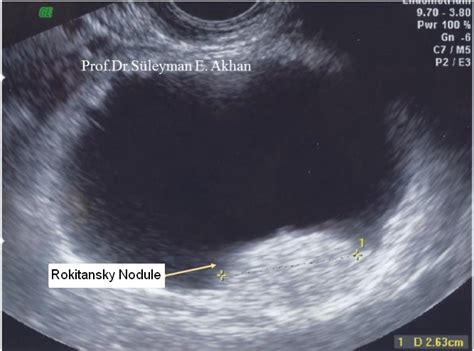 What Are The Diagnostic Methods Of Dermoid Cyst How To Diagnose