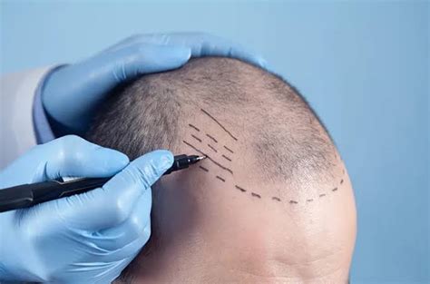 Transplantasi Rambut Manfaat Dan Risiko Yang Perlu Diketahui