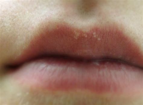 White Spots On Lips Pictures Treatment And Causes