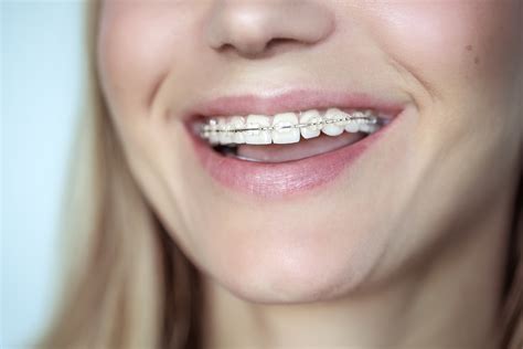 Braces Treatment For A Crooked Teeth