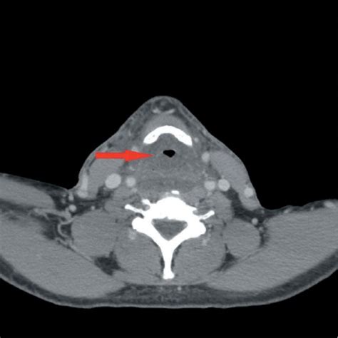 Axial Contrast Enhanced Ct Scan Of Neck Soft Tissue At The Level Of