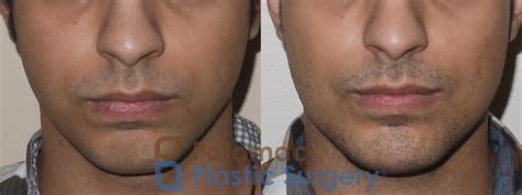 Silicone Chin And Jaw Implants To Improve The Jawline Of A Young Man