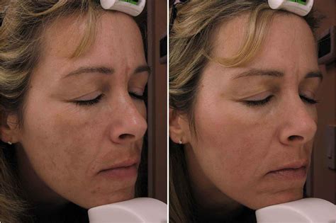 Hyperpigmentation On Face Treatment Doctor Heck