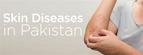 Top 5 Most Common Skin Diseases In Pakistan Mmi