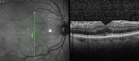 When And How To Peel An Epiretinal Membrane