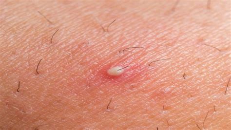 An ingrown hair cyst starts out with an ingrown hair. Ingrown Hair Cyst - Causes, Symptoms and Removal Treatment