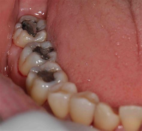Treatment Options: Dental Aesthetic with White Filling II (On Back Teeth)