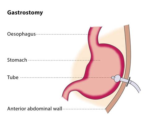 Gastrostomy Cirse