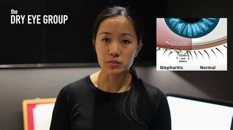 Blepharitis Treatment Blephex And Dry Eye Treatment — The Dry Eye Group