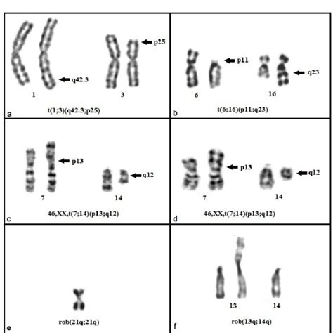 Partial Karyotypes Showing Duplication And Deletion In Chromosome 1 And