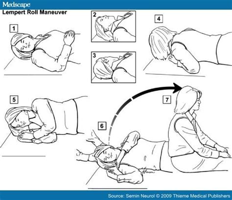 Epley Maneuver Images Frompo