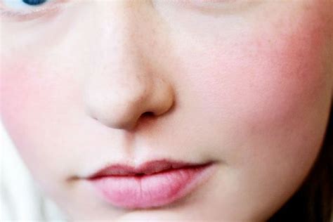 How To Get Rid Of Redness Around The Nose Perioral Intense Pulsed
