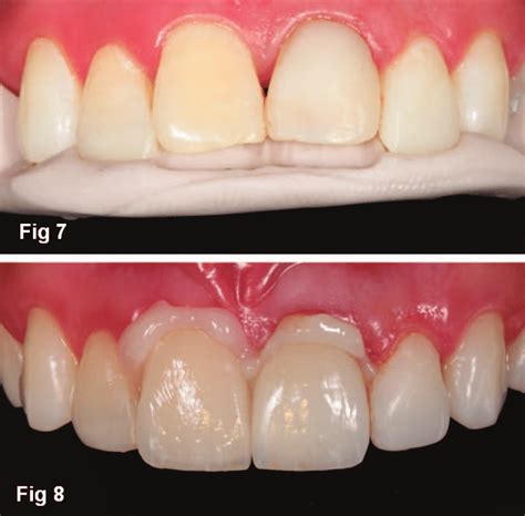 Incisal Edges With Composite Resins Performed On Teeth No 7 And No 10