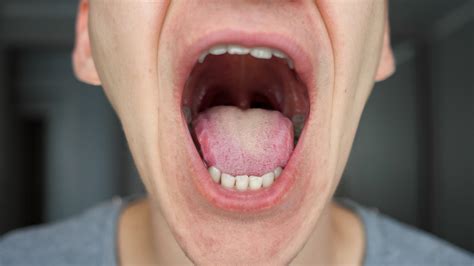 Mouth Lesions May Be A New Coronavirus Symptom Study Suggests Fox News