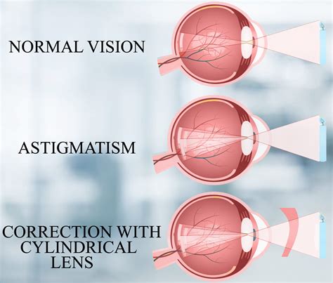 The Eye Defect Astigmatism Can Be Corrected By Usinga Convex Lensb