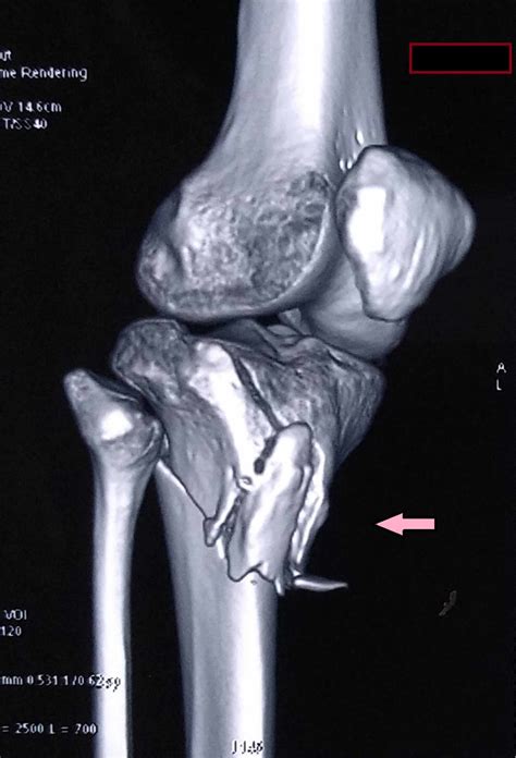 Cureus Tibial Plateau Fracture With Avulsion Fracture Of Tibial