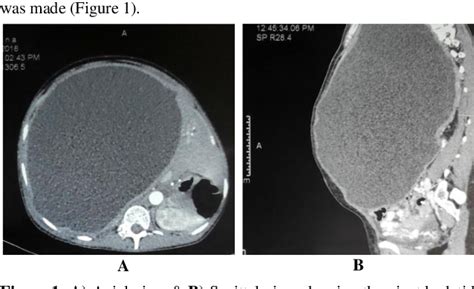 Figure 1 From Intraperitoneal Rupture Of A Giant Hydatid Cyst Of Liver