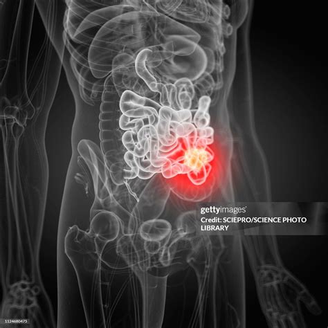 illustration of small intestine cancer high res vector graphic getty images