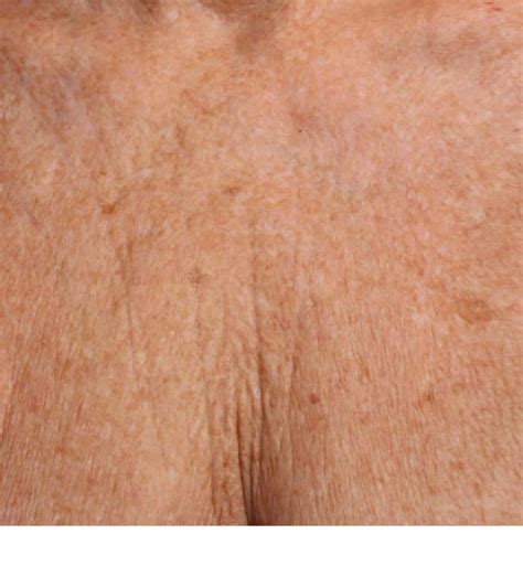 Ultherapy And Restylane For Chest Rejuvenation In London