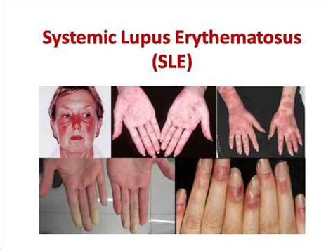 Systemic Lupus Erythematosus Sle Causes Signs Symptoms Treatment Youtube