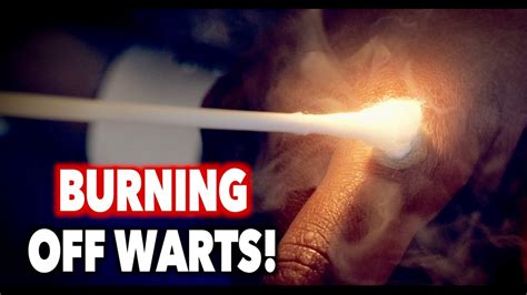 Burning Off Warts With Liquid Nitrogen Dr Paul Youtube