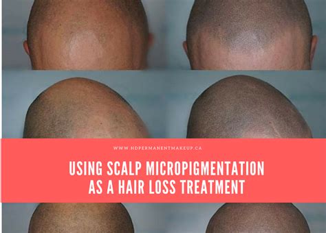 Scalp Micropigmentation As A Hair Loss Treatment Hd Beauty Academy