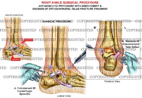 Right Ankle Arthroscopic Debridement — Medical Art Works