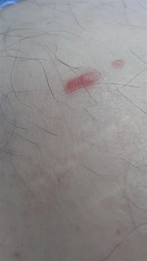 Raised Red Bump On Leg For Two Weeks Now No Puss Or Skin Break