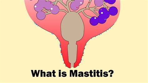 What Is Mastitis Disease Full Video Youtube