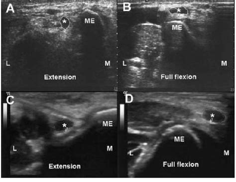 Transverse Sonograms Show Displacement Of The Ulnar Nerve During
