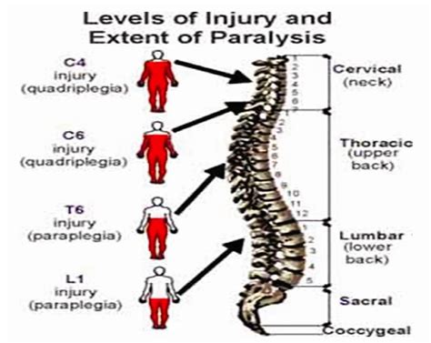 Quadriplegia Tetraplegia Definition Causes Symptoms