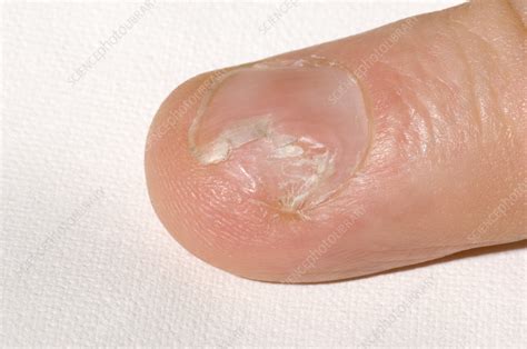 Fungal Nail Infection Stock Image M1600082 Science Photo Library