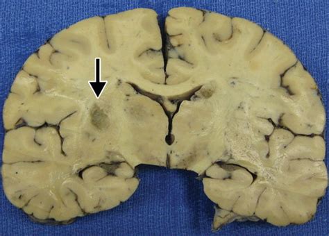 Cerebral Toxoplasmosis Radiographics