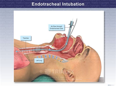 Endotracheal Intubation Trial Exhibits Inc