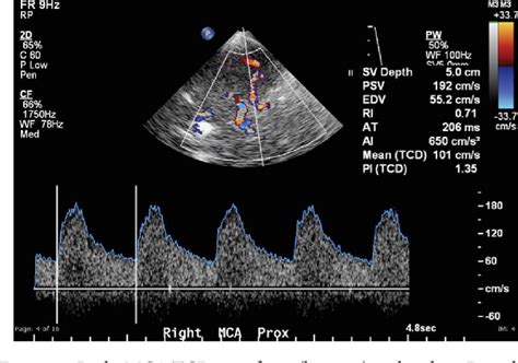 Pdf Transcranial Doppler Ultrasound A Review Of The Physical
