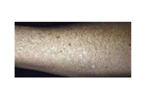 What Causes White Freckles On The Arms And When To Seek Medical Advice