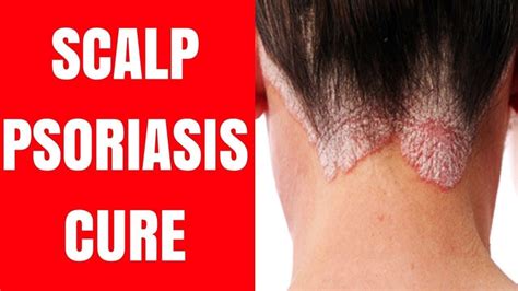 Pin By Clipping Retouch On Health And Beauty Scalp Psoriasis Cure