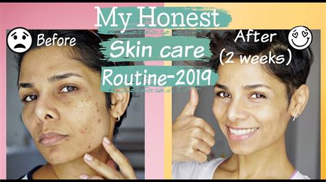 How To Get Rid Of Acne Discoloration And Uneven Skin Tone Skin Care